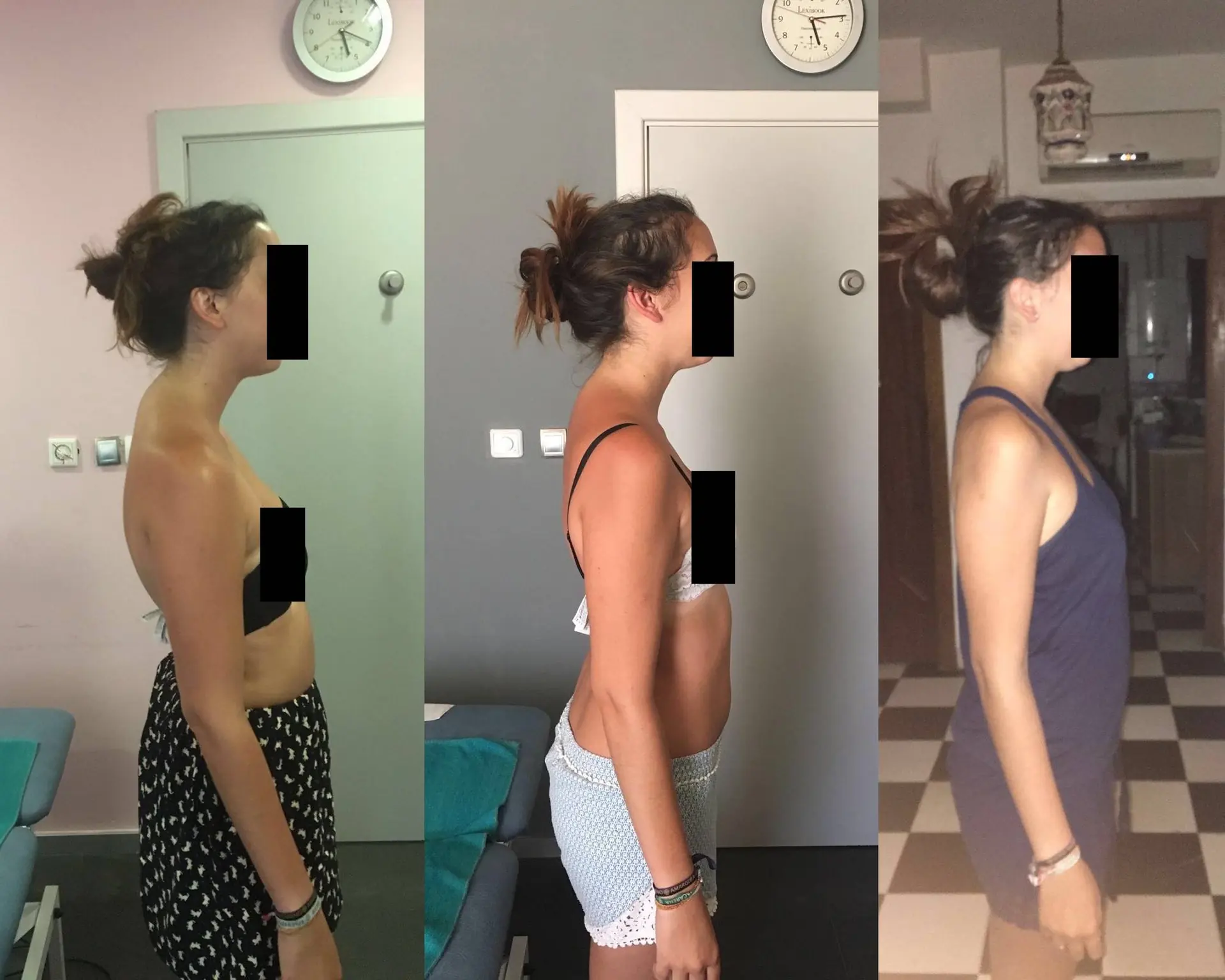 Lola Martín González (25 Años). Dolor crónico de espalda y corrección postural