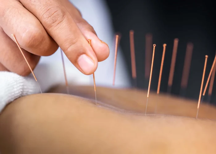 qué es la acupuntura