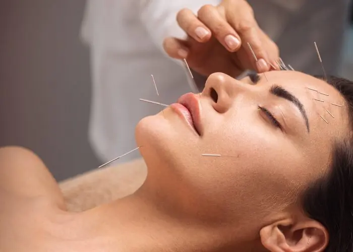 beneficios de la acupuntura